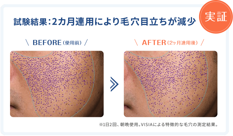 【実証】試験結果：2カ月連用により毛穴目立ちが減少。使用前と使用後の写真。※1日2回、朝晩使用。VISIAによる特徴的な毛穴の測定結果。