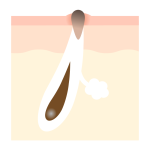 黒ずみ毛穴