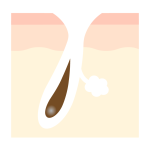 開き毛穴