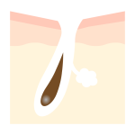 たるみ毛穴